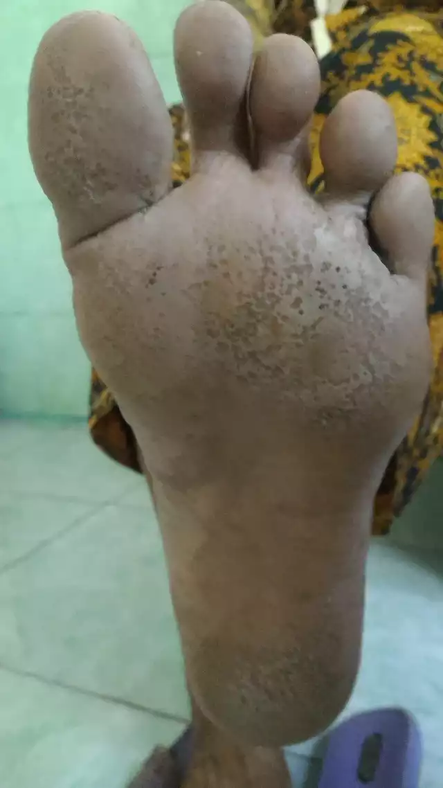 Příznaky pitted keratolysis na podrážce nohy s prohlubněmi.