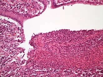 Histologický příznak zánětlivého střeva u Crohnovy choroby