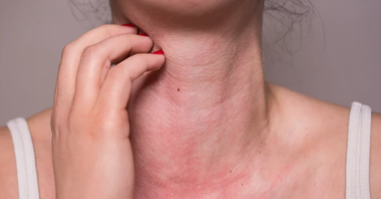 Červená svědivá vyrážka na krku při alergie