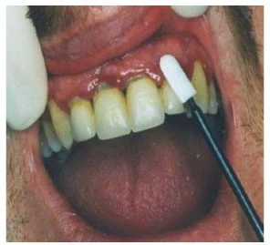 Zubní hygiena s bavlněným tamponem při biologické léčbě.