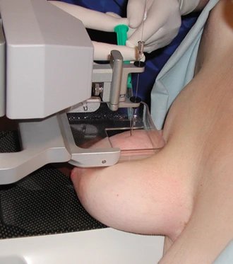 Biopsie prsu pomocí jehly pod kontrolou přístroje.