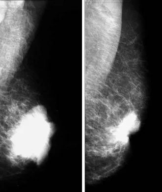 Mammografie prsu ukazující hustotu tkáně bez zjevných abnormalit.